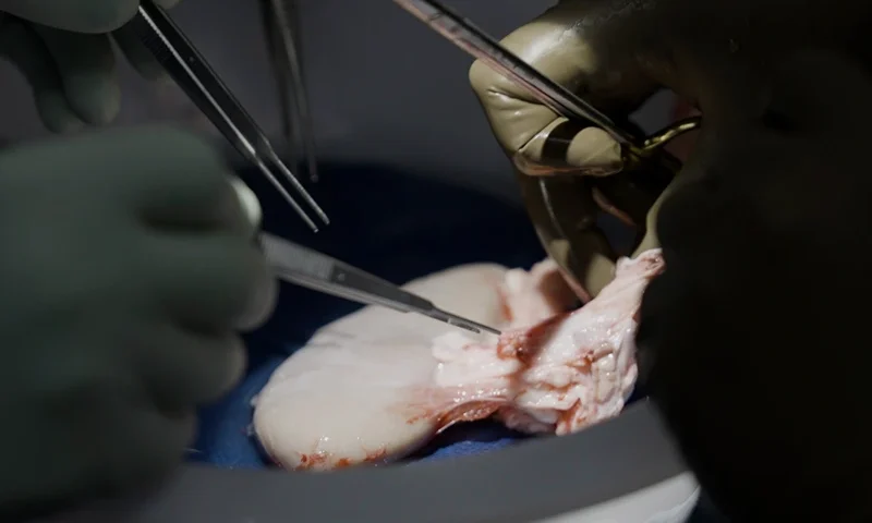 Pig Human Transplants Surgeons at NYU Langone Health prepare to transplant a pig's kidney into a brain-dead man in New York on July 14, 2023. Researchers around the country are racing to learn how to use animal organs to save human lives. (AP Photo/Shelby Lum)