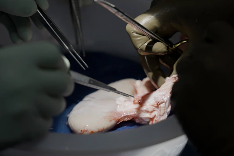 Pig Human Transplants
Surgeons at NYU Langone Health prepare to transplant a pig's kidney into a brain-dead man in New York on July 14, 2023. Researchers around the country are racing to learn how to use animal organs to save human lives. (AP Photo/Shelby Lum)