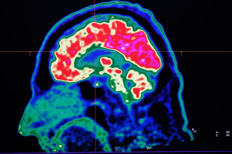 FRANCE-HEALTH-HOSPITAL-SCIENCE-RESEARCH
A picture of a human brain taken by a positron emission tomography scanner, also called PET scan, is seen on a screen on January 9, 2019, at the Regional and University Hospital Center of Brest (CRHU - Centre Hospitalier Régional et Universitaire de Brest), western France. The CHRU of Brest has just acquired a new molecular imaging device, the most advanced in France today according to the hospital center, capable of better detecting deep lesions and especially cancerous pathologies, the hospital announced on January 9, 2019. (Photo by Fred TANNEAU / AFP) (Photo by FRED TANNEAU/AFP via Getty Images)