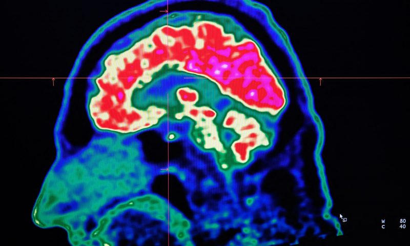 FRANCE-HEALTH-HOSPITAL-SCIENCE-RESEARCH A picture of a human brain taken by a positron emission tomography scanner, also called PET scan, is seen on a screen on January 9, 2019, at the Regional and University Hospital Center of Brest (CRHU - Centre Hospitalier Régional et Universitaire de Brest), western France. The CHRU of Brest has just acquired a new molecular imaging device, the most advanced in France today according to the hospital center, capable of better detecting deep lesions and especially cancerous pathologies, the hospital announced on January 9, 2019. (Photo by Fred TANNEAU / AFP) (Photo by FRED TANNEAU/AFP via Getty Images)