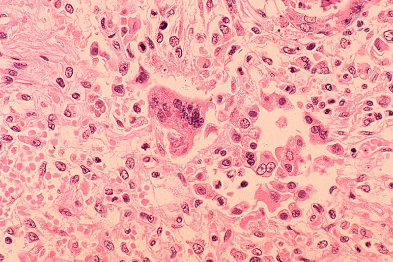 1972: In this handout from the Centers for Disease Control and Prevention (CDC), a histopathology of measles pneumonia is seen in this microscope image from 1972. Measles outbreaks have been reported throughout the U.S., with the latest reported February 5, 2015 at a daycare in suburban Chicago where as many as five children under the age of one have been infected. (Photo by CDC via Getty Images)
